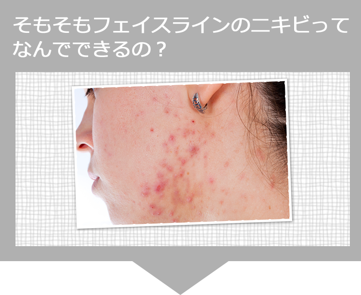 そもそもフェイスラインのニキビってなんでできるの？